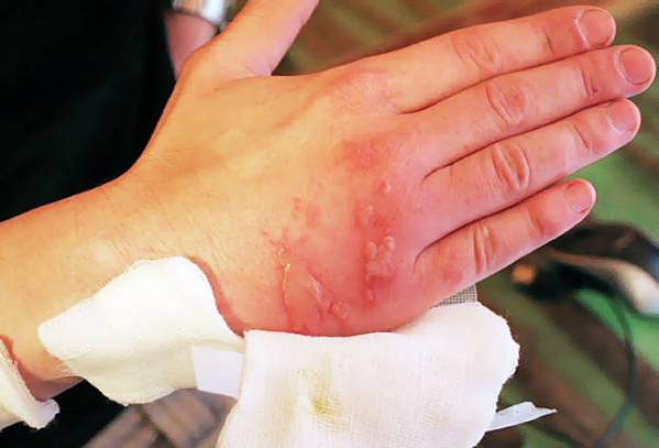 Хімічний опік на руці